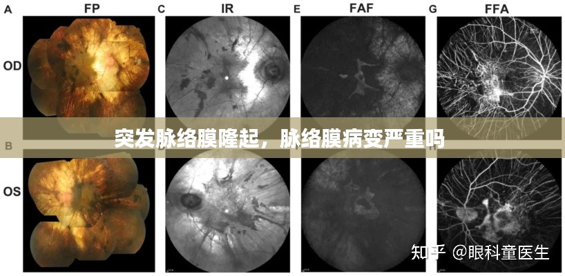 突发脉络膜隆起，脉络膜病变严重吗 