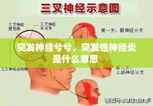 突发神经兮兮，突发性神经炎是什么意思 